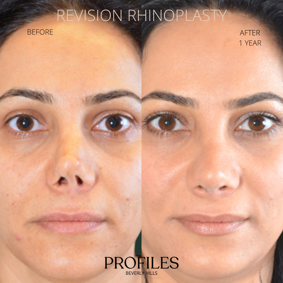 Female face, before and after Revision Rhinoplasty treatment, front view, patient 3