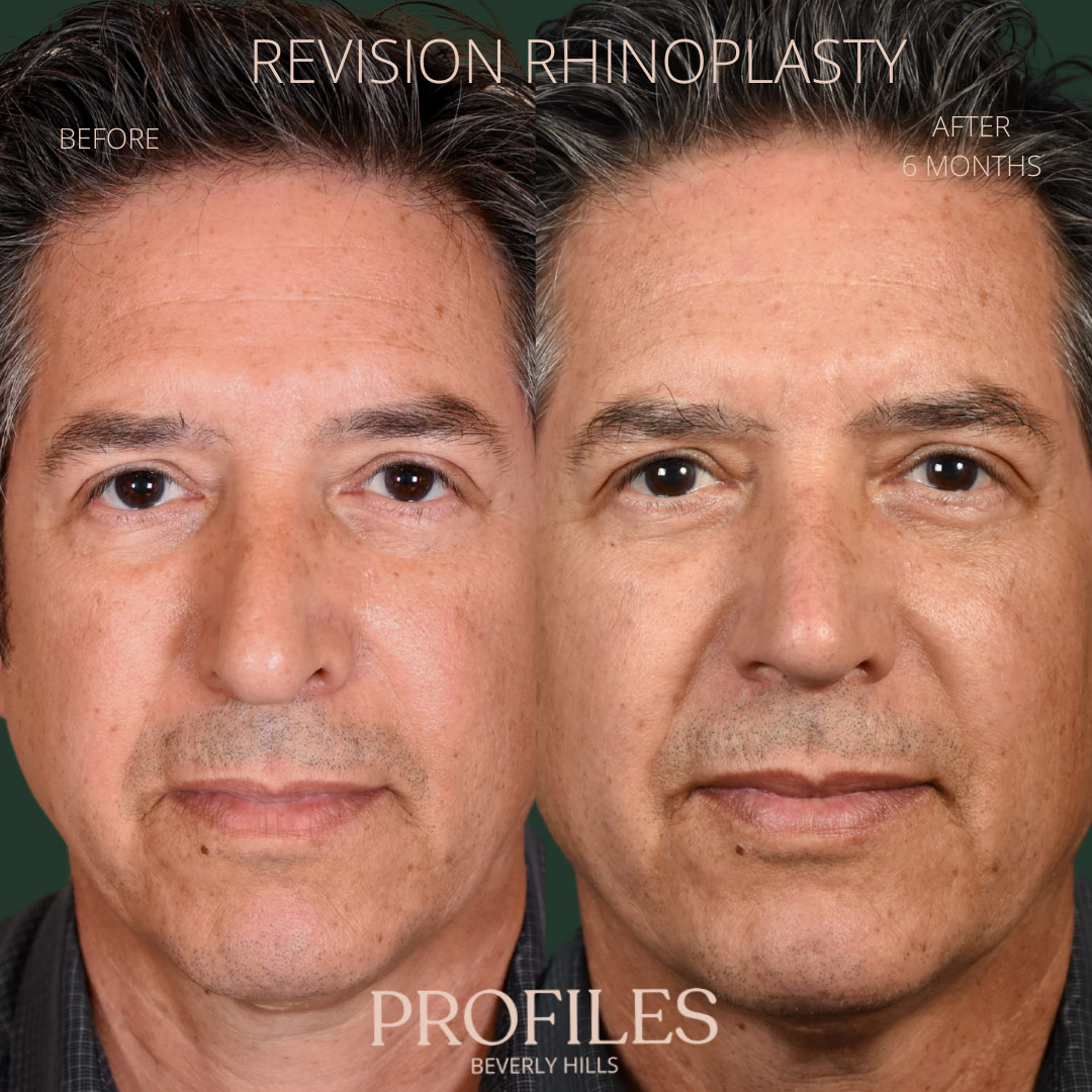 Male face, before and after Revision Rhinoplasty treatment, front view, patient 5