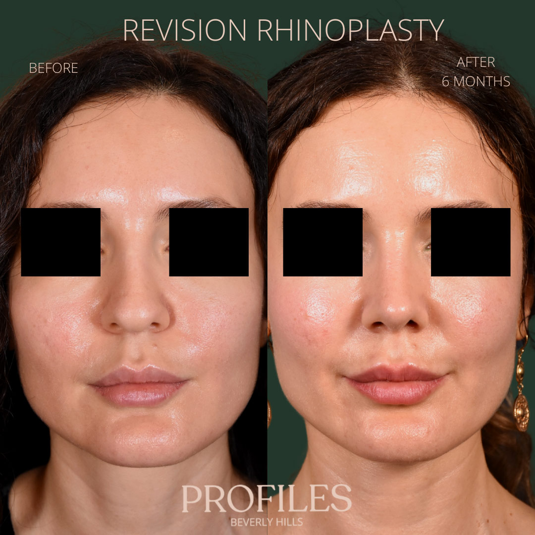 Woman’s face, before and after Revision Rhinoplasty treatment, front view, patient 6
