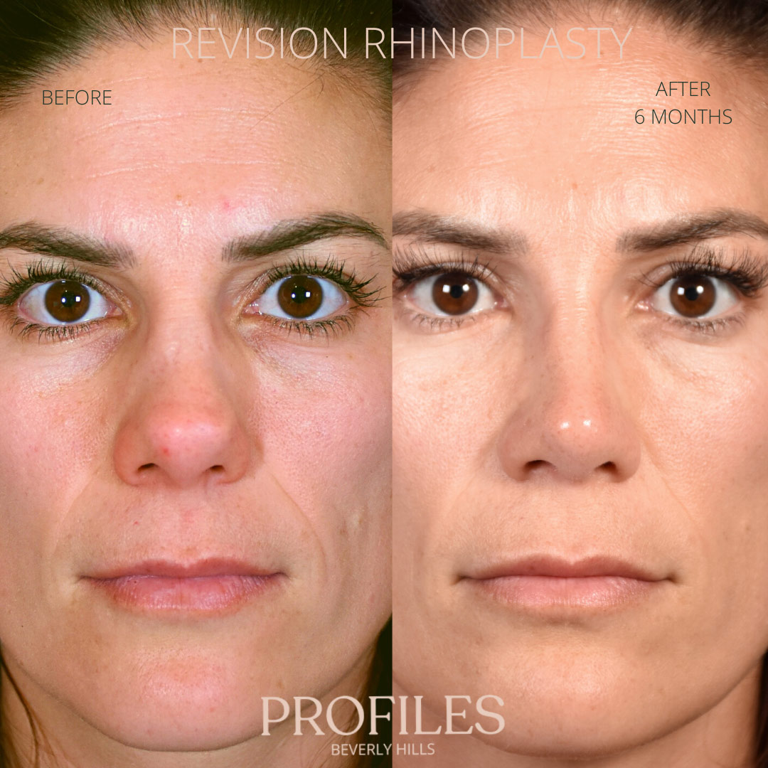 Woman’s face, before and after Revision Rhinoplasty treatment, front view, patient 8