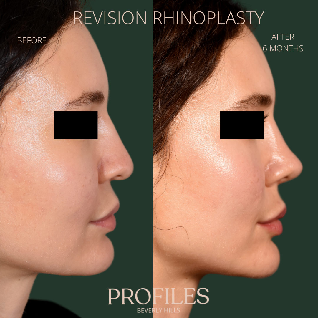 Female face, before and after Revision Rhinoplasty treatment, r-side view, patient 10