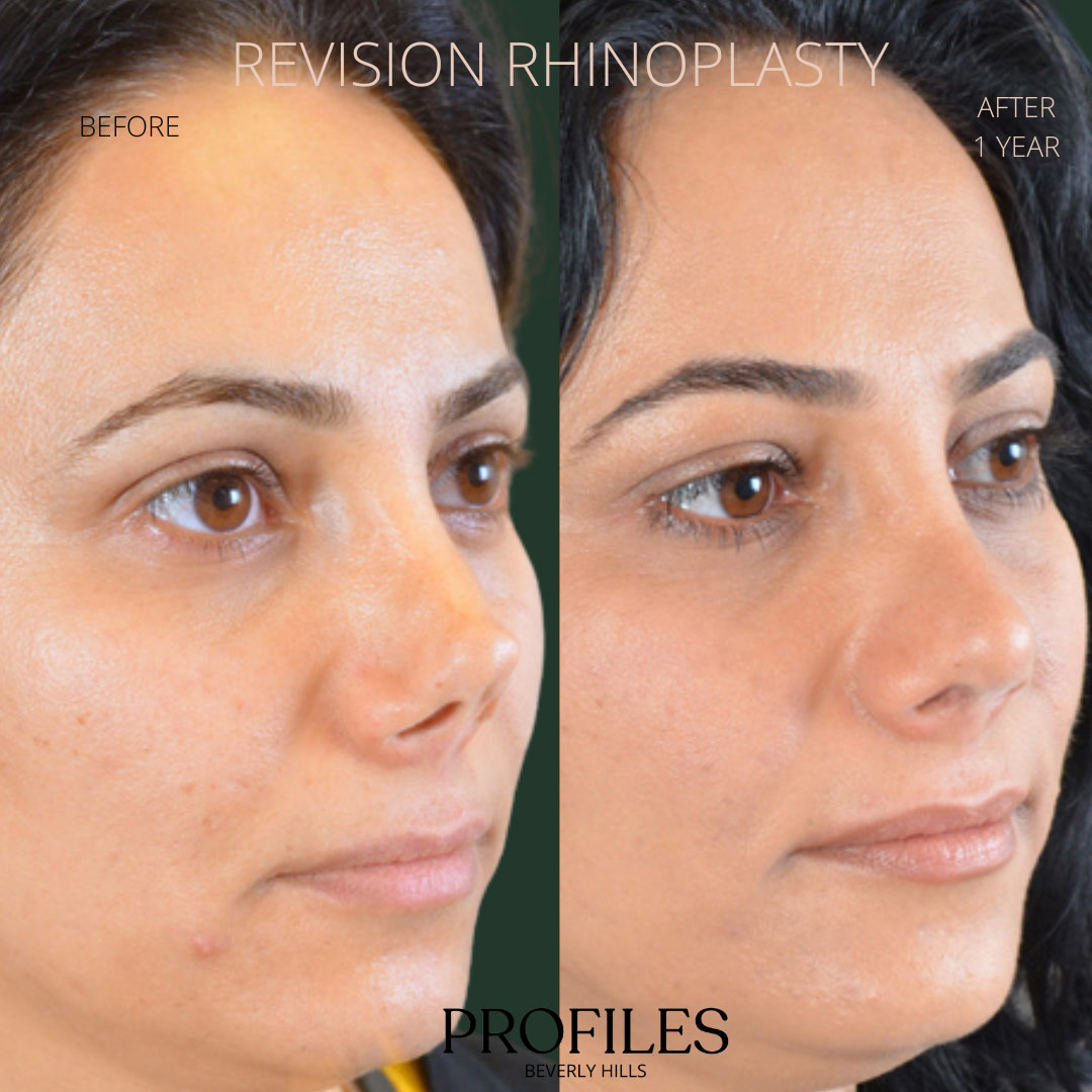 Female face, before and after Revision Rhinoplasty treatment, r-side view, patient 11