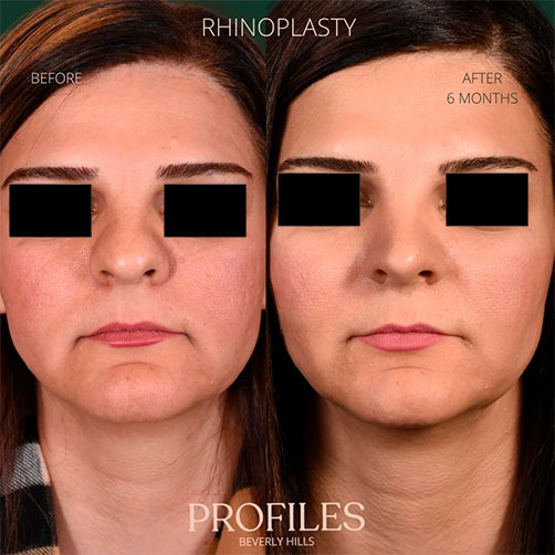 Woman’s face, before and after Rhinoplasty treatment, front view, patient 6