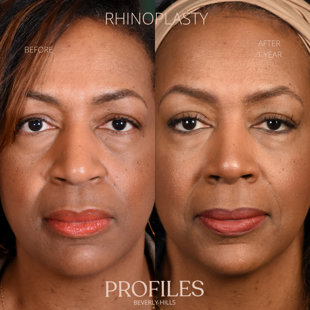 Woman’s face, before and after African American Rhinoplasty treatment, front view, patient 5