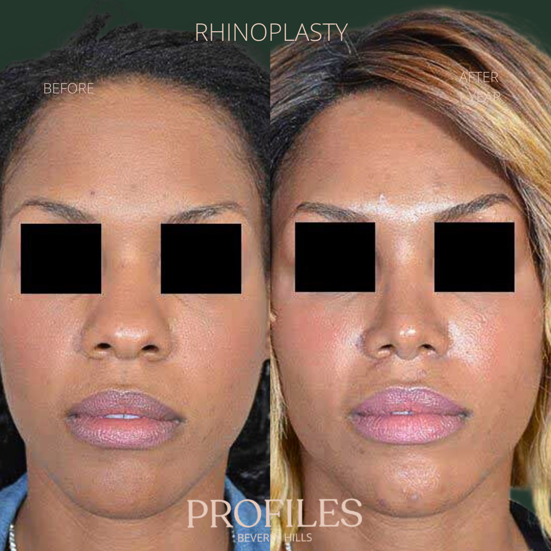 Woman’s face, before and after African American Rhinoplasty treatment, front view, patient 2