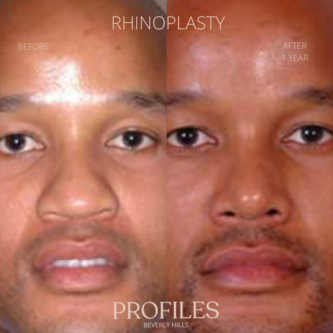 Male face, before and after African American Rhinoplasty treatment, front view, patient 3