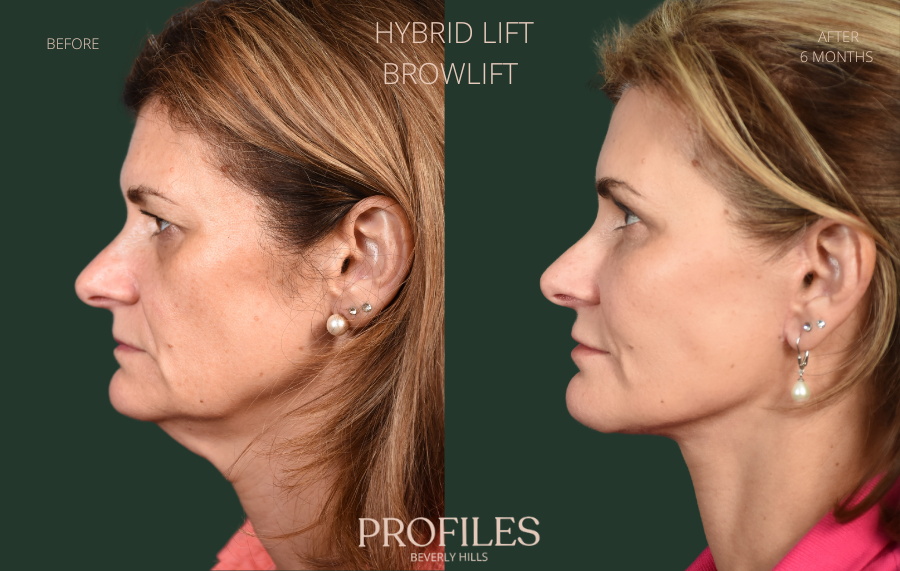 Facelift Before and After Photo Gallery