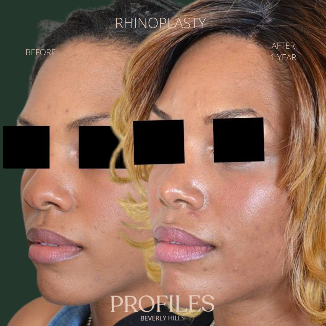 Woman’s face, before and after African American Rhinoplasty treatment, l-side oblique view, patient 2