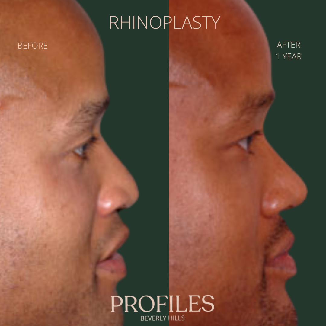 Male face, before and after African American Rhinoplasty treatment, r-side view, patient 3