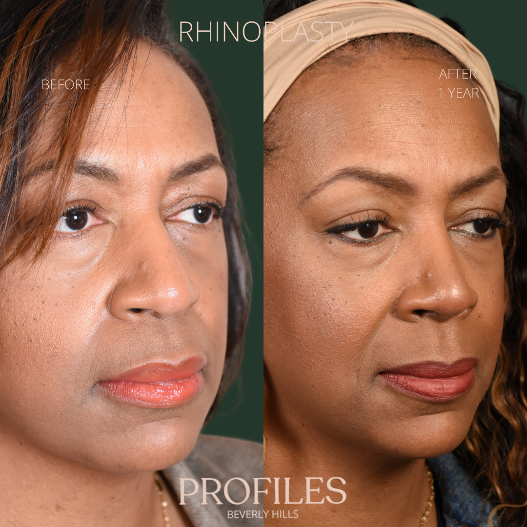 Woman’s face, before and after African American Rhinoplasty treatment, r-side oblique view, patient 5