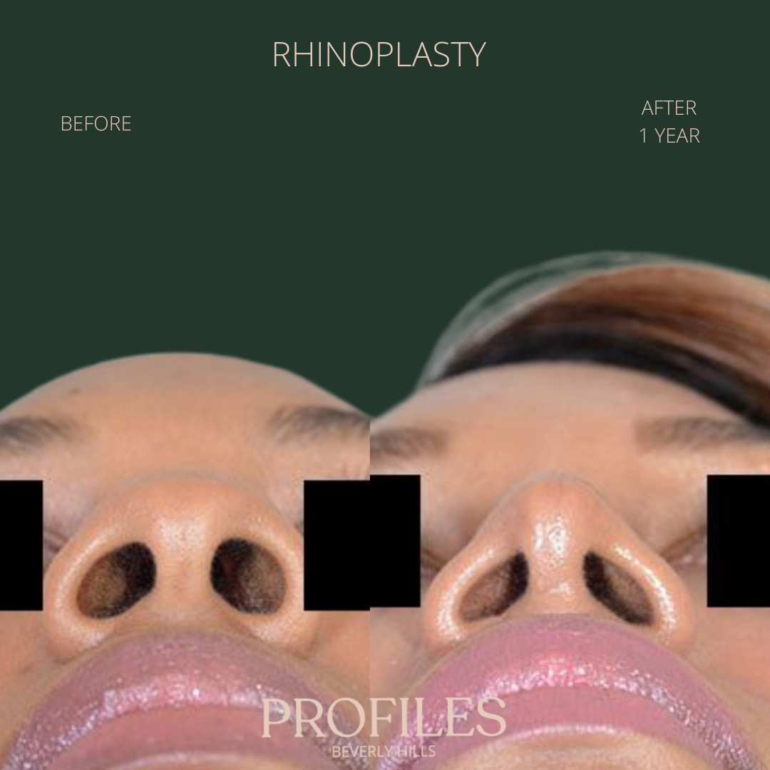 Woman’s nose, before and after African American Rhinoplasty treatment, bottom view, patient 2