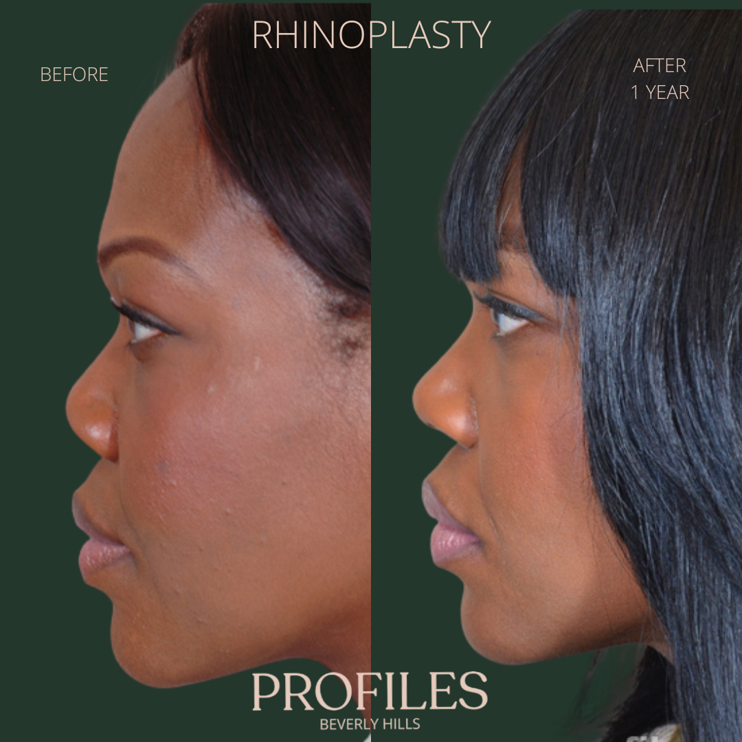 Woman’s face, before and after African American Rhinoplasty treatment, l-side view, patient 4