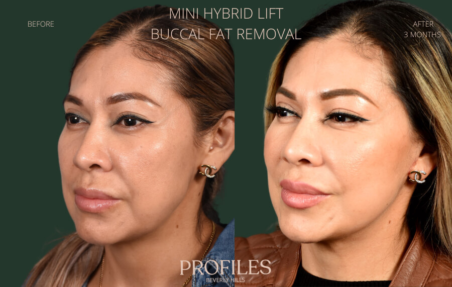 Buccal fat removal woman patient before and after photo