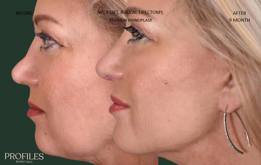 Neck lift, buccal lipectomy revision rhinoplasty woman patient before and after photo