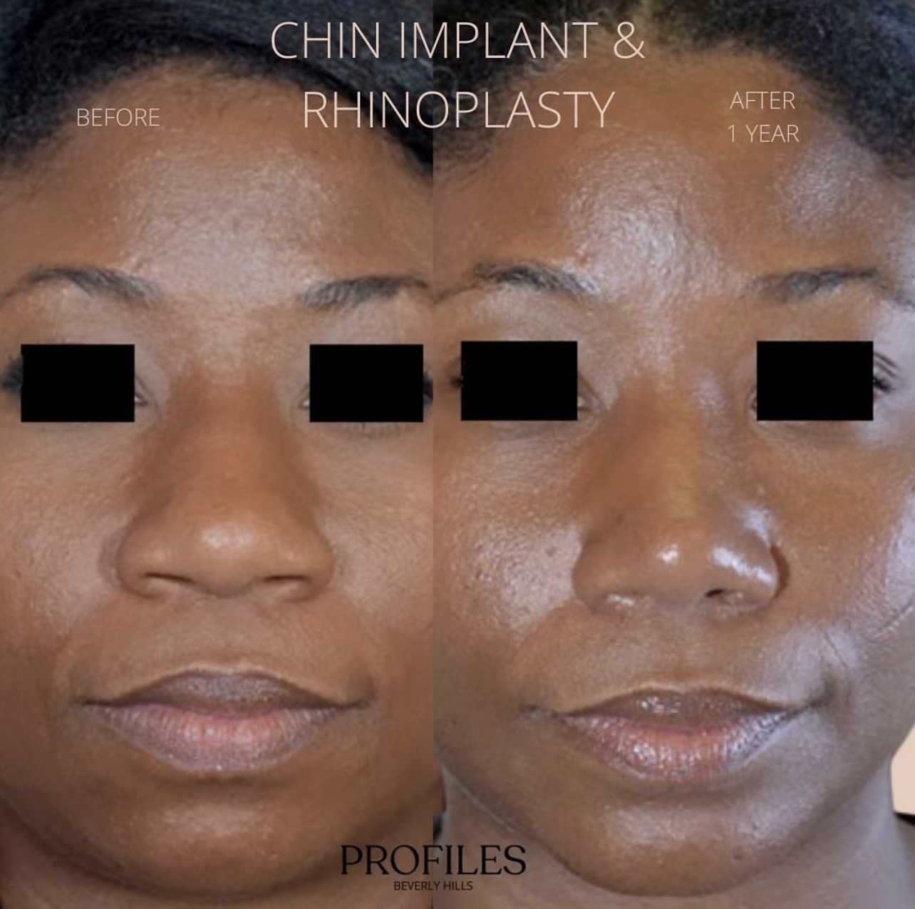 Woman’s face, before and after African American Rhinoplasty treatment, front view, patient 6