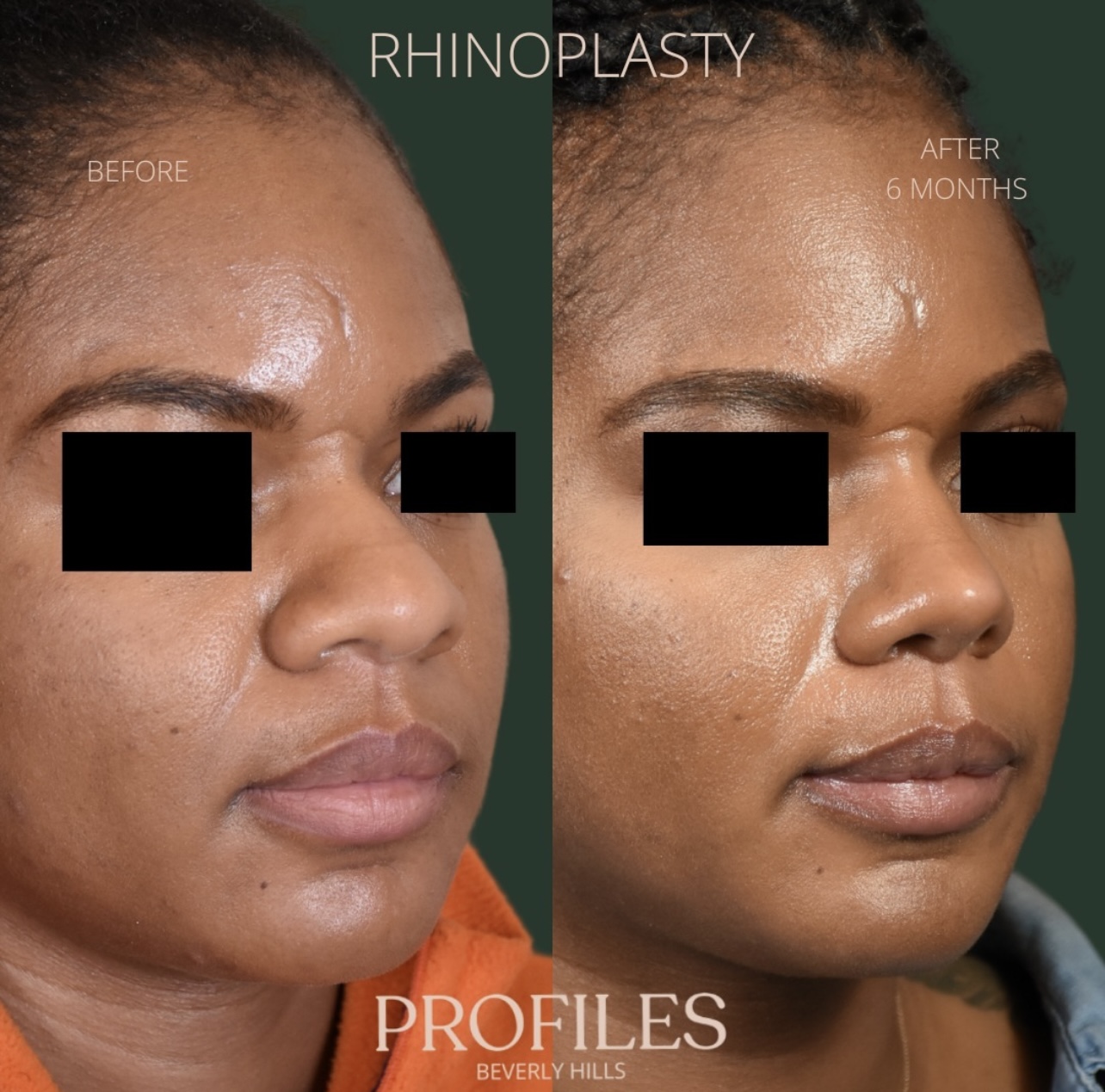 Woman’s face, before and after African American Rhinoplasty treatment, r-side oblique view - patient 1