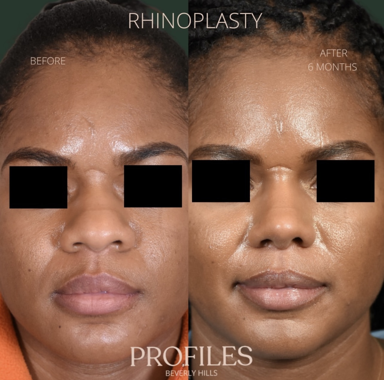 Woman’s face, before and after African American Rhinoplasty treatment, front view, patient 1