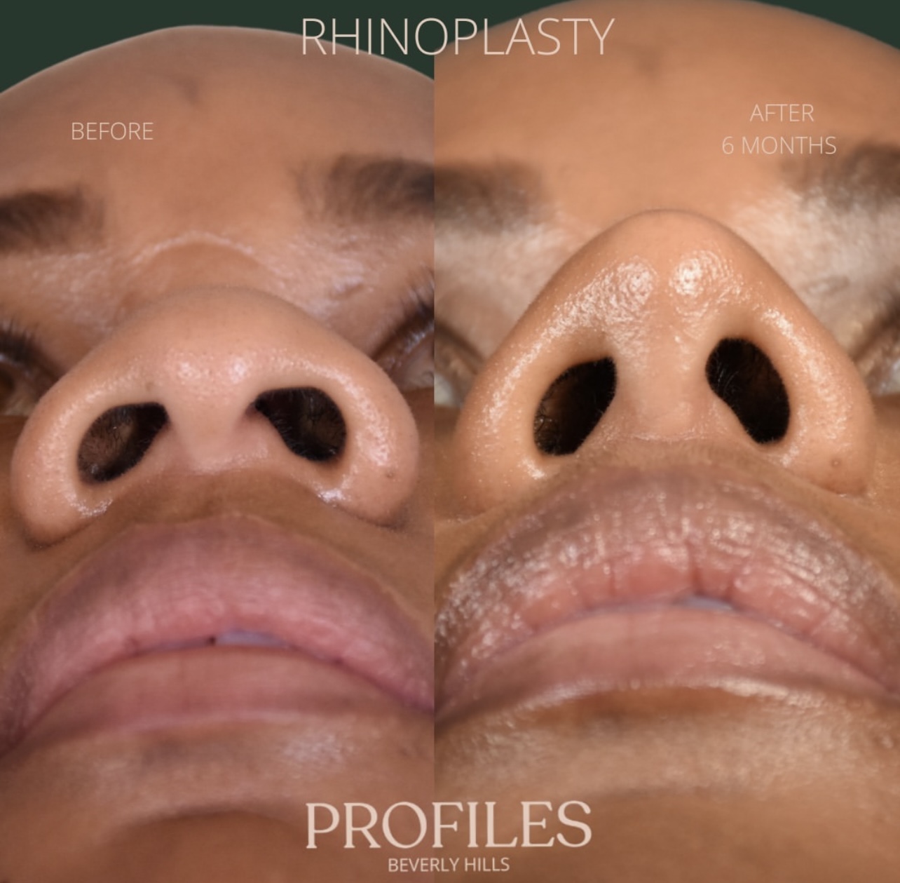 Woman’s nose, before and after African American Rhinoplasty treatment, underside view, patient 5