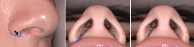 Female nose, before and after Rhinoplasty treatment, oblique / underside view - (narrow nostrils)