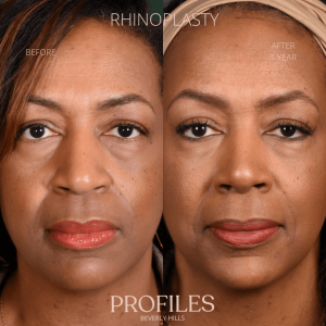 Female face, before and after African American Rhinoplasty treatment, front view, patient 5