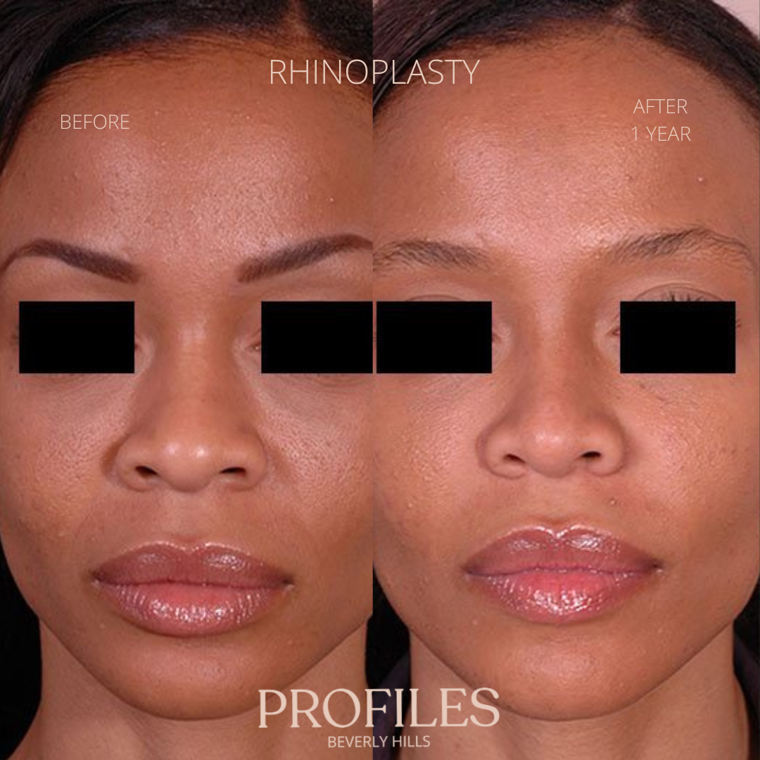 Woman’s face, before and after African American Rhinoplasty treatment, front view, patient 7
