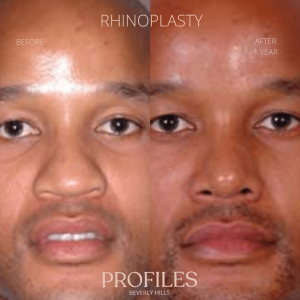 Male face, before and after African American Rhinoplasty treatment, front view - patient 3