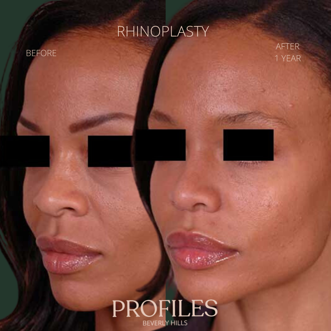 Woman’s face, before and after African American Rhinoplasty treatment, l-side oblique view, patient 7