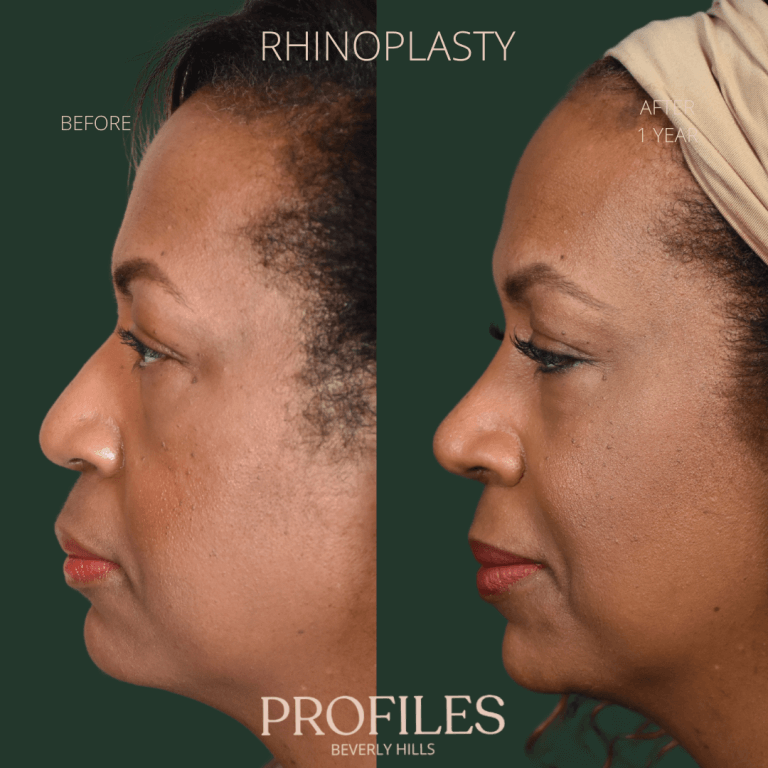 Female face, before and after African American Rhinoplasty treatment, l-side view, patient 5