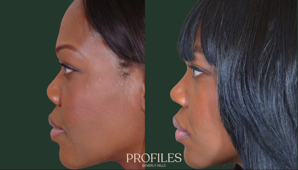 Female face, before and after African American Rhinoplasty treatment, l-side view, patient 4
