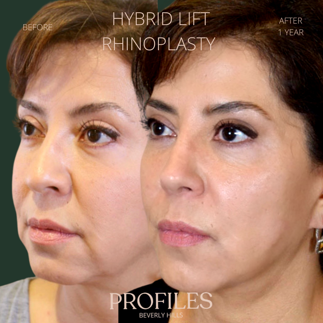 Female face, before and after Hybrid Lift, Rhinoplasty treatment, l-side oblique view, patient 5