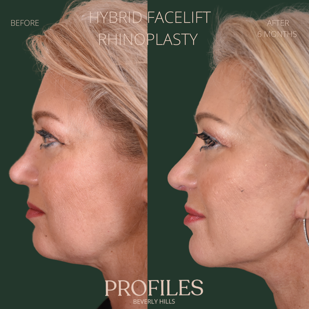 Female face, before and after Hybrid Facelift, Rhinoplasty treatment, l-side view, patient 8