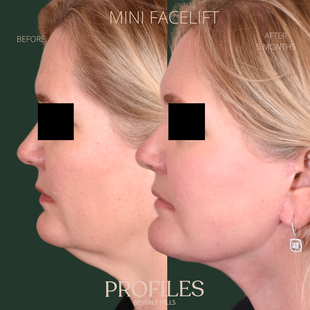 Female face, before and after Mini Facelift treatment, l-side view, patient 1