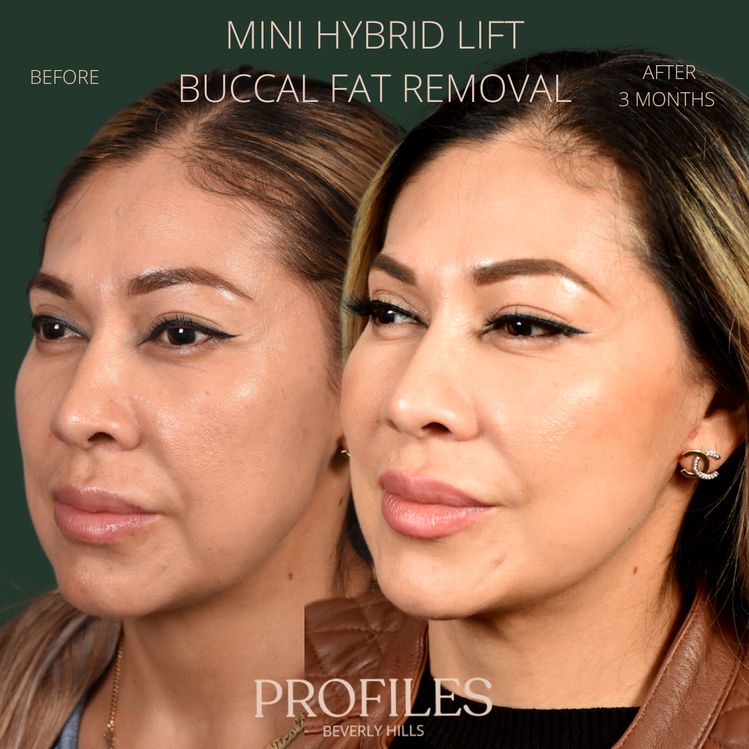 Female face, before and after Mini Hybrid lift buccal fat removal treatment, l-side oblique view, patient 2