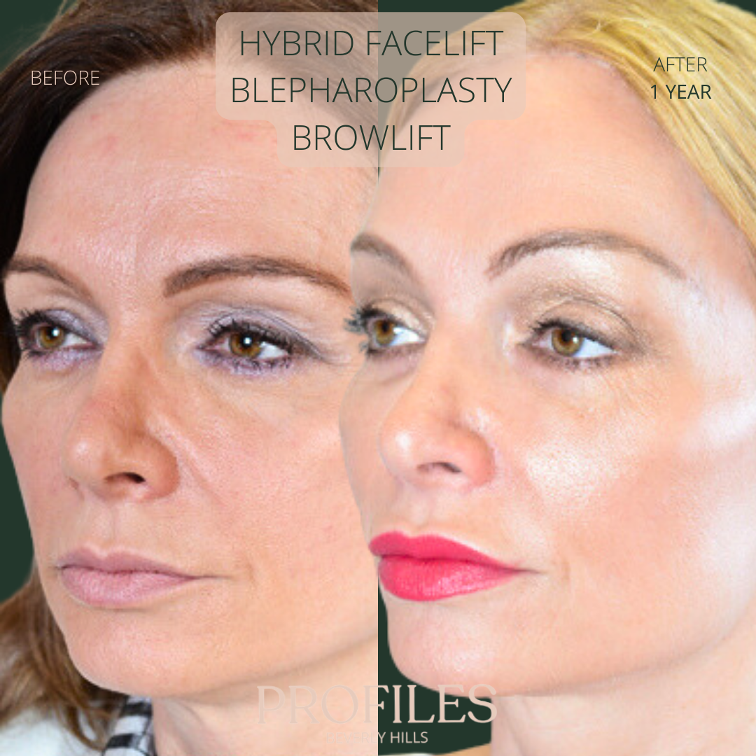 Female face, before and after Hybrid Facelift, Blepharoplasty, Browlift treatment, l-side oblique view, patient 10