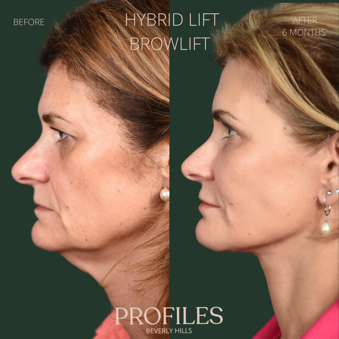 Female face, before and after Hybrid Lift, Browlift treatment, l-side view, patient 2