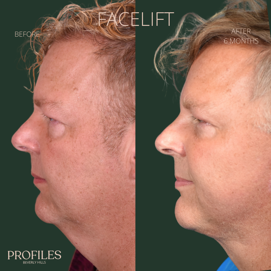 Male face, before and after Facelift, treatment, l-side view, patient 4