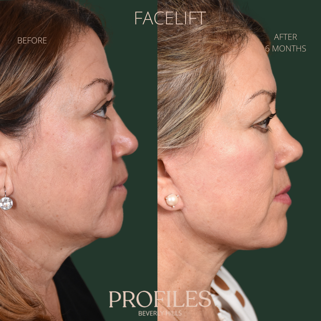 Female face, before and after Facelift, treatment, r-side view, patient 9