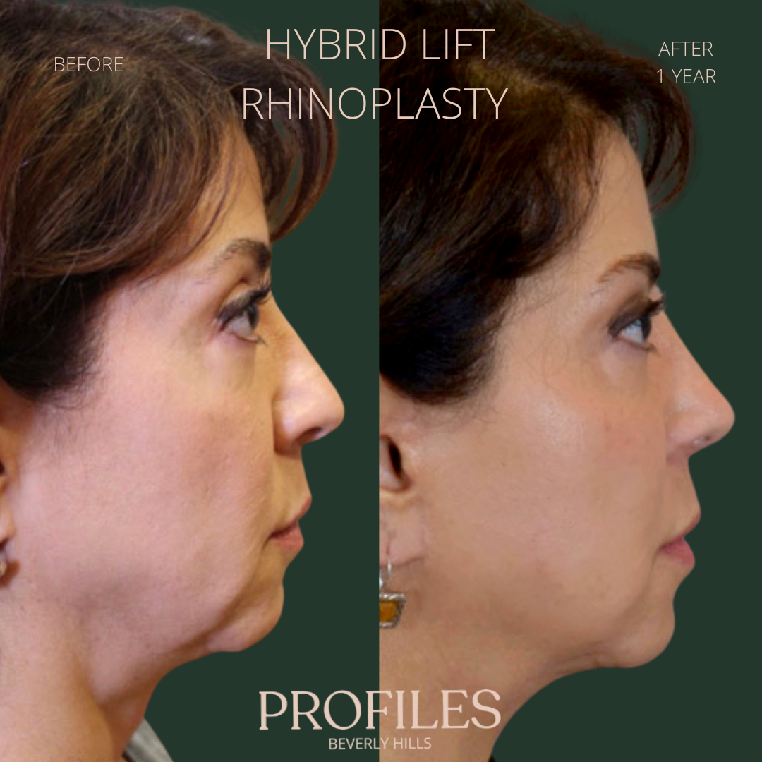 Female face, before and after Hybrid Lift, Rhinoplasty treatment, r-side view, patient 5