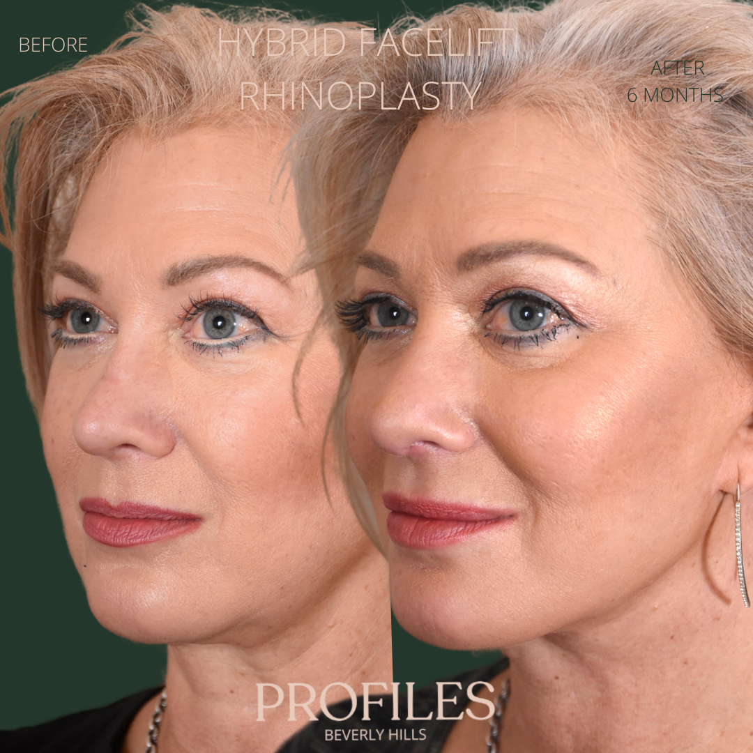 Female face, before and after Hybrid Facelift, Rhinoplasty treatment, l-side oblique view, patient 8
