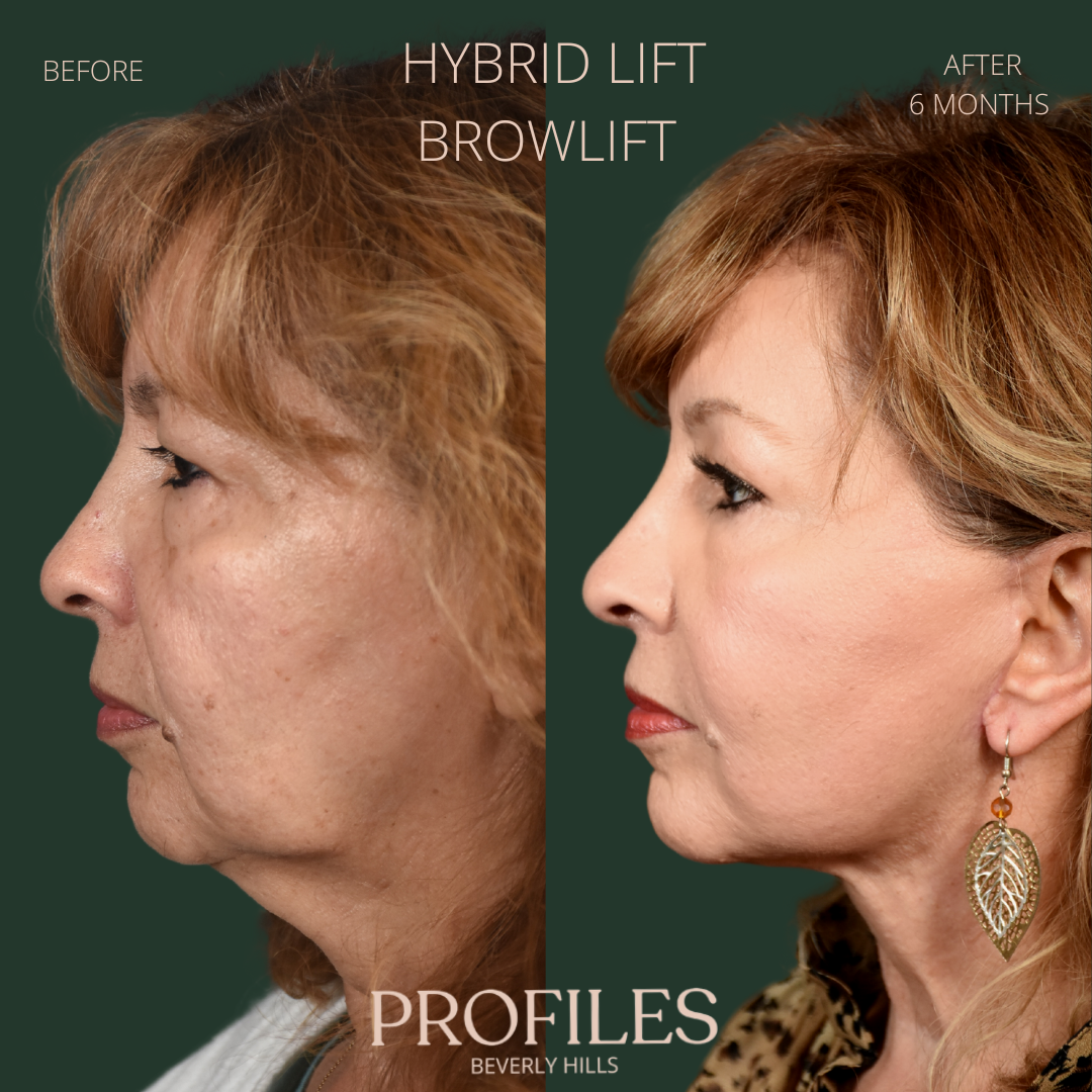 Female face, before and after Hybrid Lift, Browlift treatment, l-side view, patient 3