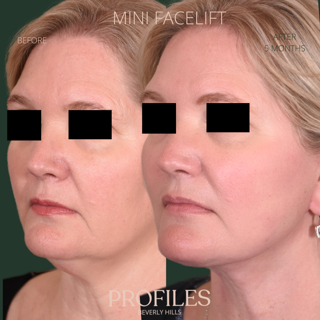 Female face, before and after Mini Facelift treatment, l-side oblique view, patient 1