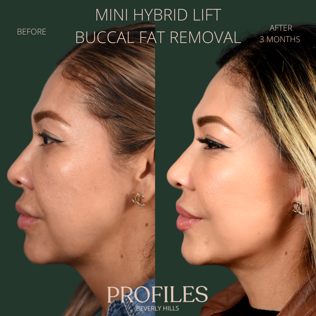 Female face, before and after Mini Hybrid lift buccal fat removal treatment, l-side view, patient 2