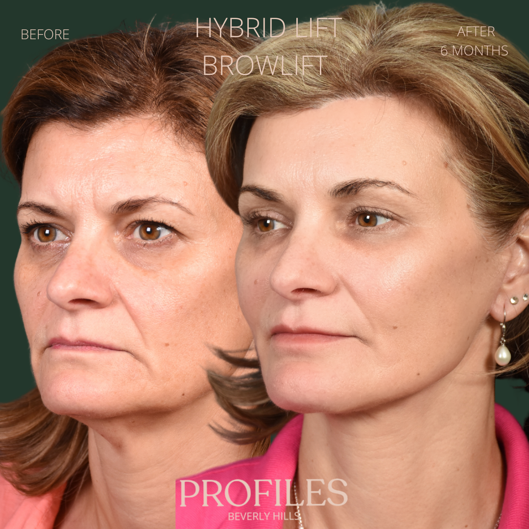 Female face, before and after Hybrid Lift, Browlift treatment, l-side oblique view, patient 2