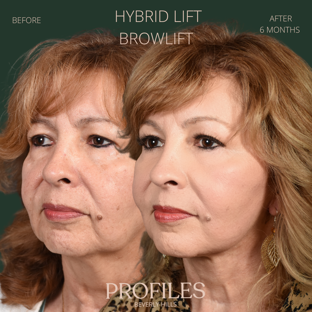 Female face, before and after Hybrid Lift, Browlift treatment, l-side oblique view, patient 3