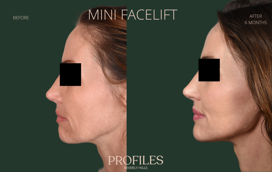 Mini-lift. Before Treatment Photo - female, front view, patient 1