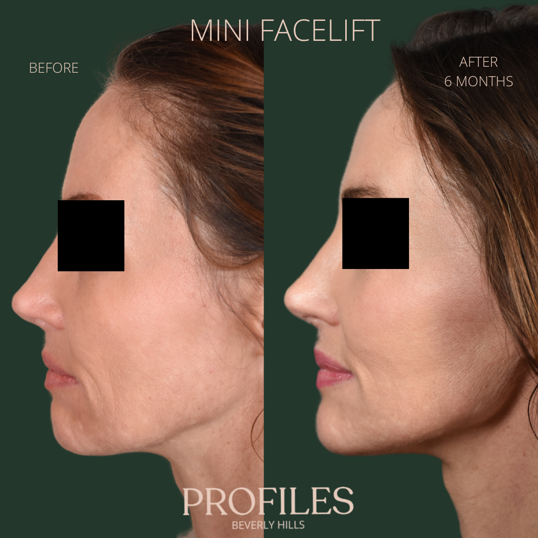 Female face, before and after 6 months, Mini Facelift treatment, l-side view, patient 3