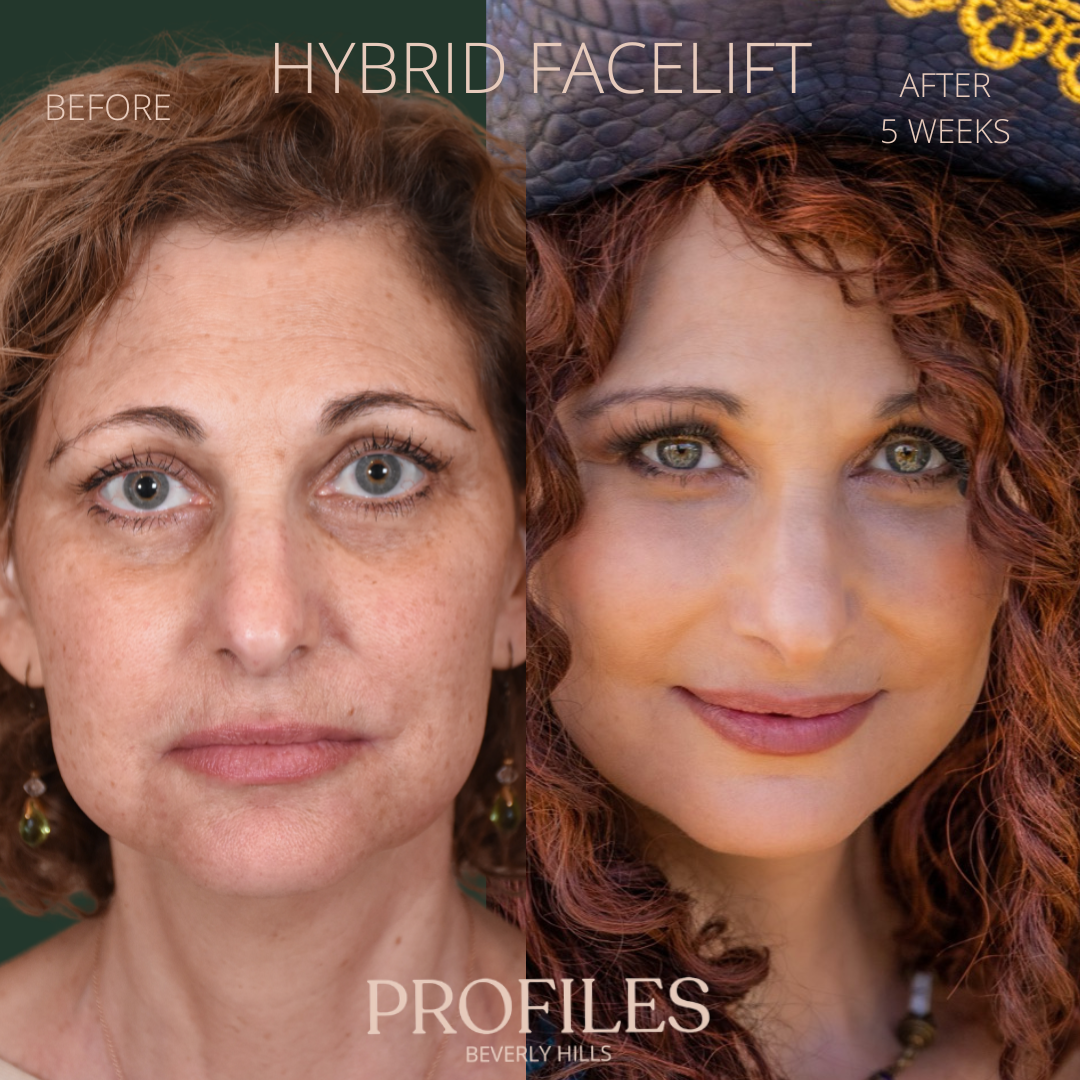 Female face, before and after Hybrid Facelift treatment, front view, patient 1