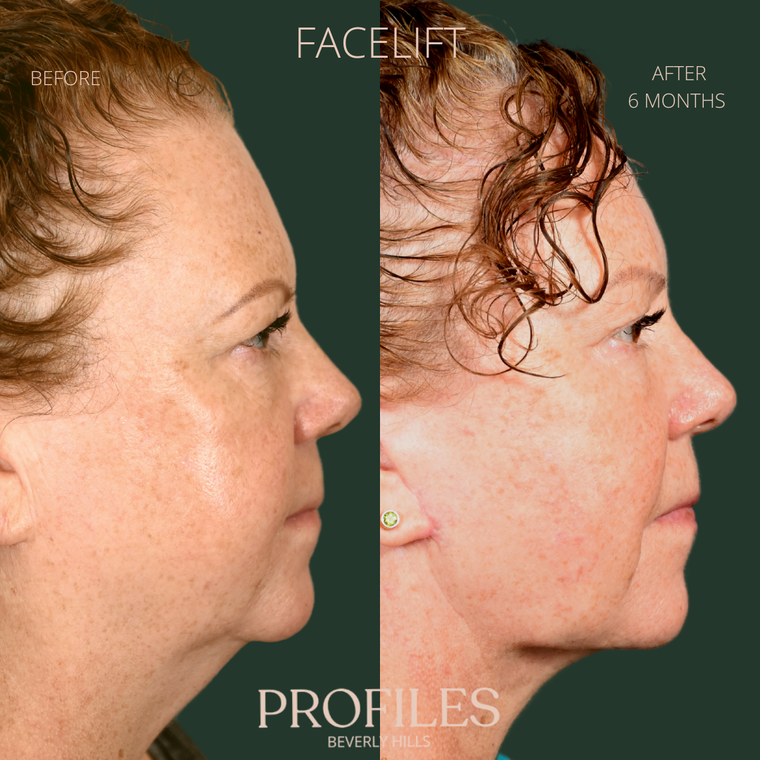 Female face, before and after Facelift, treatment, r-side view, patient 6