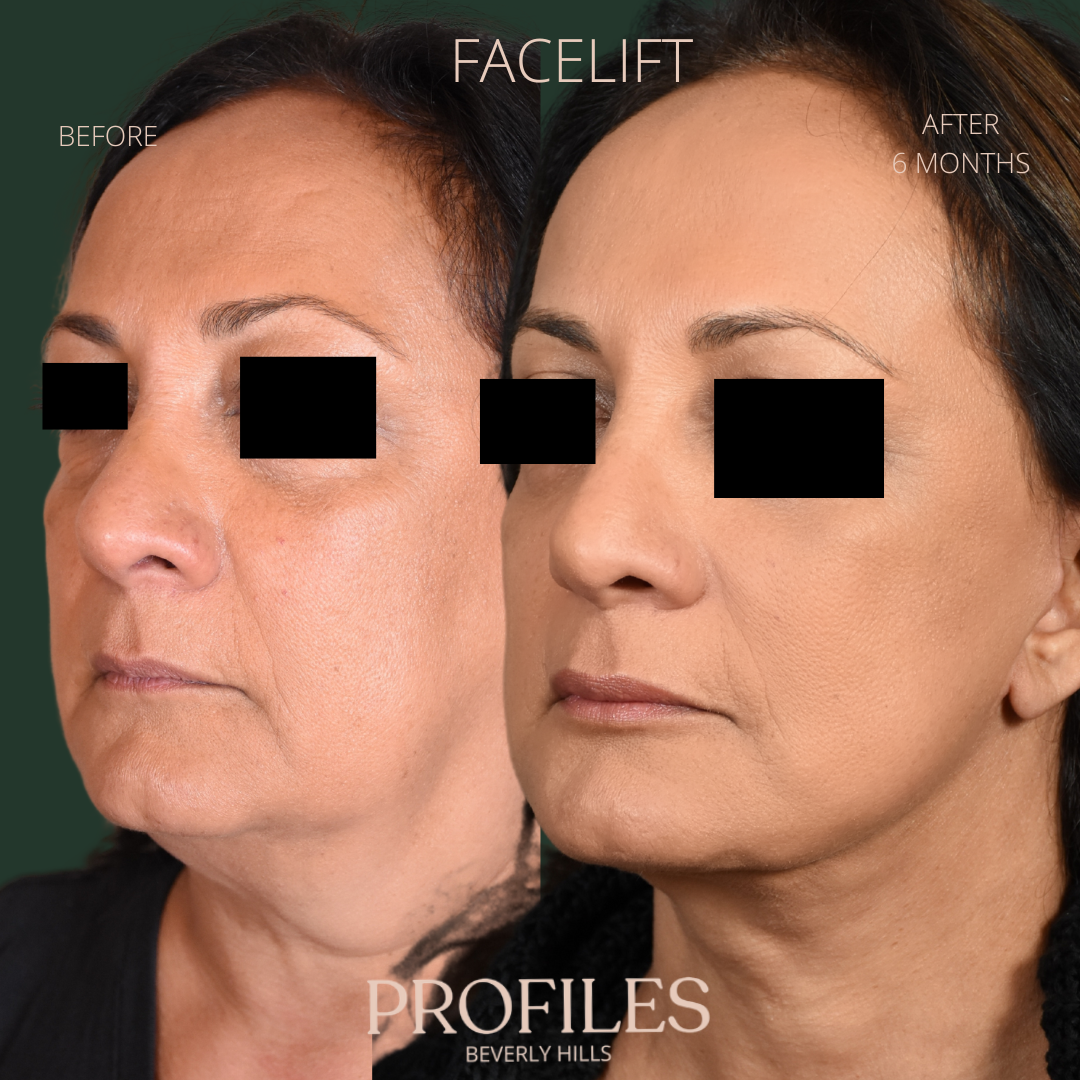 Female face, before and after Facelift treatment, l-side oblique view, patient 7