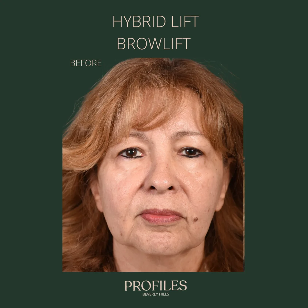 Hybrid lift brow lift photo